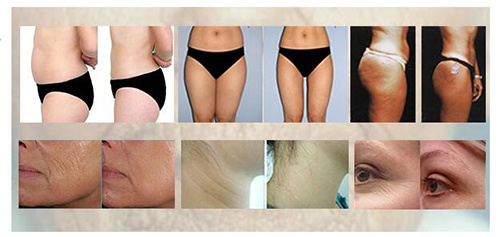 Portable Radio Frequency RF Lifting Face Lifting Slimming Treatment
