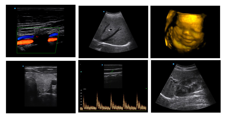4D Ultrasound Imaging System Obstetrics, Gynecology, Tissue Harmonic Imaging, Compound Imaging, 4D Transducer, Volumetric Probe