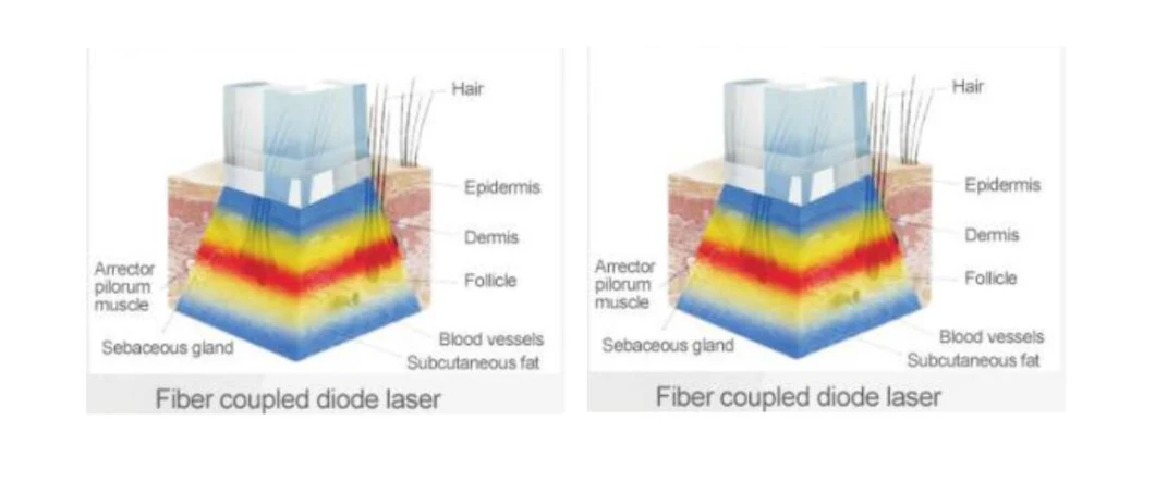 Fiber Coupled Diode Laser Hair Removal Machine Beijing Noblelaser Hair Removal System