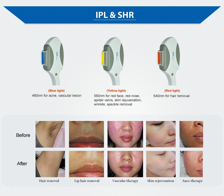 Opt Operating System Painless Hair Removal IPL Shr Hair Removal