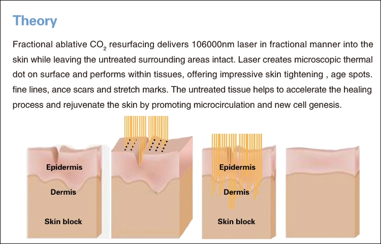 Carbon Dioxide Laser Skin Renaissance Beauty Machine