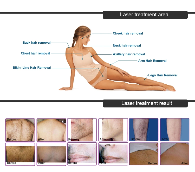 Aesthetic Diode Laser Hair Removal Medical Aesthetic Equipment
