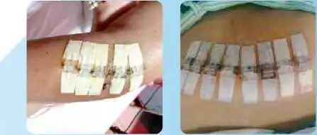 Noninvasive Skin Wound Closure Device Surgical Sutures Skin Glues Stapler