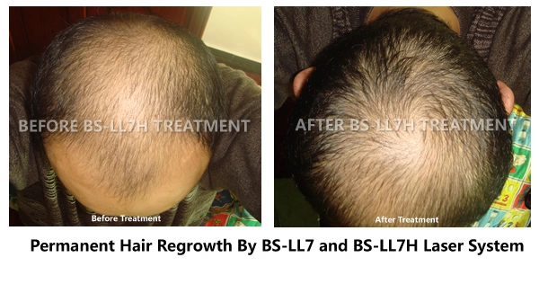Multifunctional Hair Regrowth Machine Hair Restoration/ Laser Hair Growth Diode 808nm