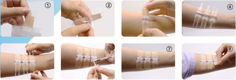 Newest Noninvasive Zip Wound Skin Closure Set