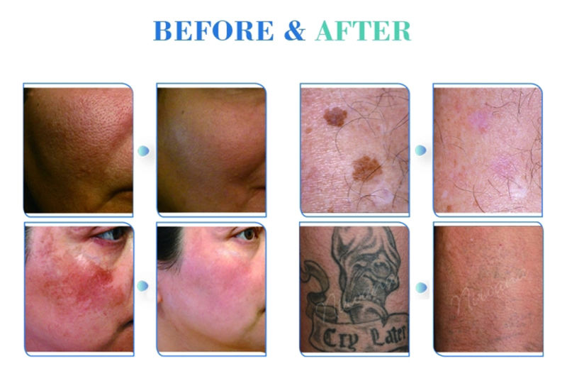 New ND YAG Laser Pico for Skin Rejuvenation Tattoo Remove
