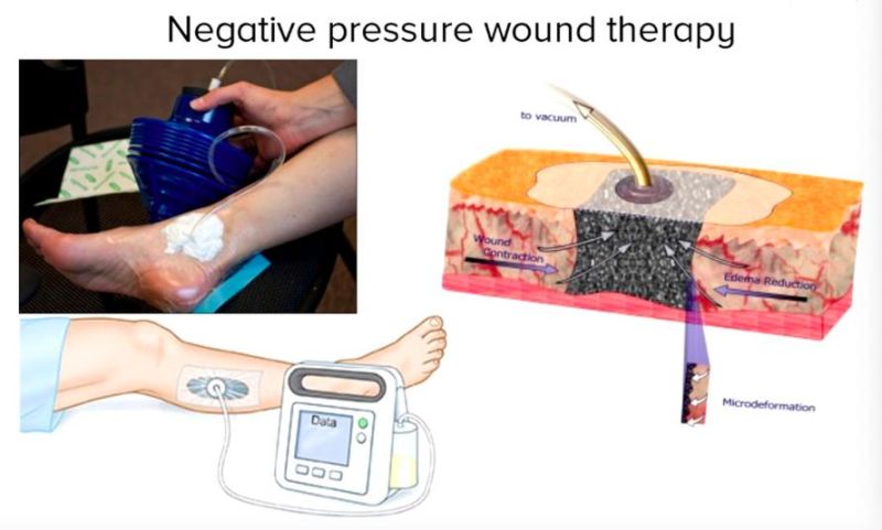 Negative Pressure Wound Therapy System VAC Npwt Machine with Dressing in Stock Medical Devices Equipment Rainhome