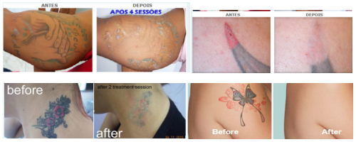 Q Switch ND YAG Laser Tattoo Removal &Skin Rejuvenation Machine