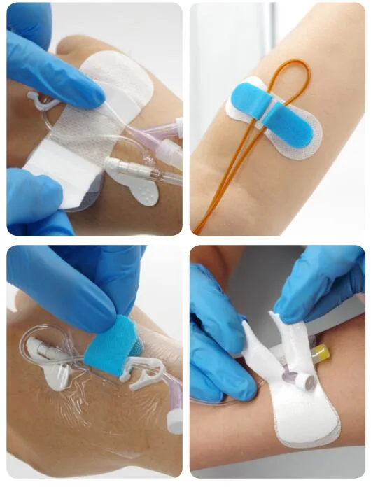 Medical Supplies Waterproof IV Fixation Transparent Medical Disposable Surgical Wound Care Dressing Bandages Instruments