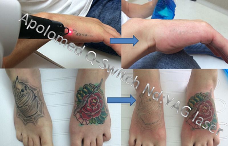 ND YAG New Laser for Skin Rejuvi and Tattoo Removal Without Cream