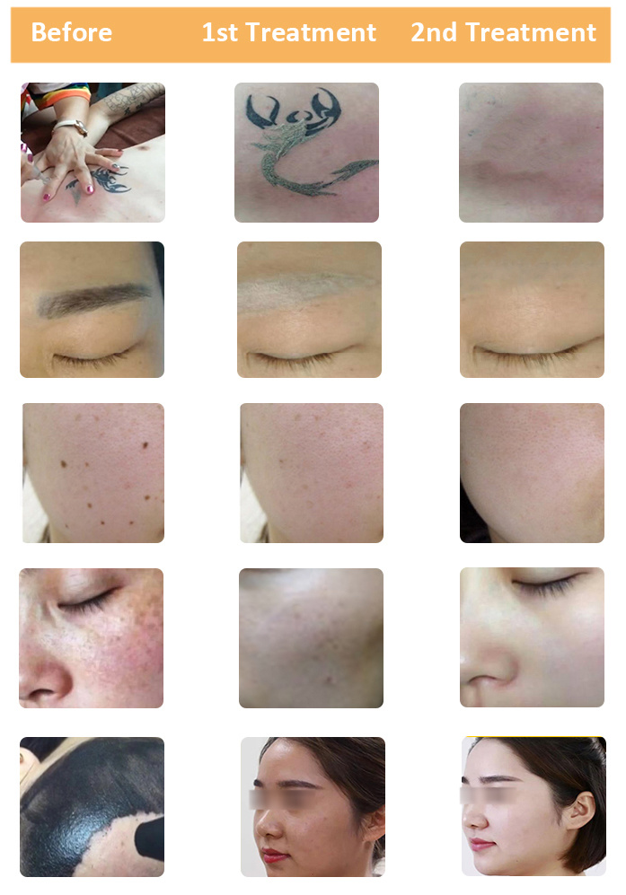 Tattoo Removal Skin Whitening 532nm 1064nm 1320nm ND YAG Laser System