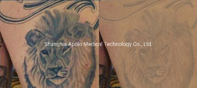 Tattoo Removal and Eyelines Removal Skin Care Q-Switched ND YAG Laser Picosecond