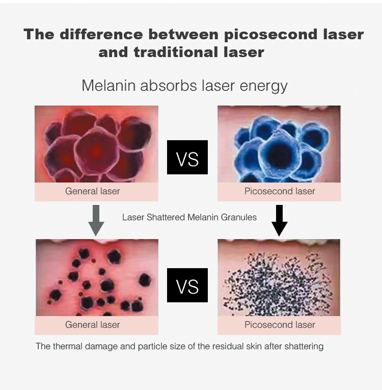 Vertical Picosecond Laser Tattoo Removal 755nm Skin Rejuvenation Machine