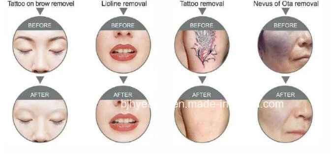 Laser Tattoo Removal Laser 755nm Laser Pico Second Laser Tattoo Remover755nm 1320nm 532nm 1064nm