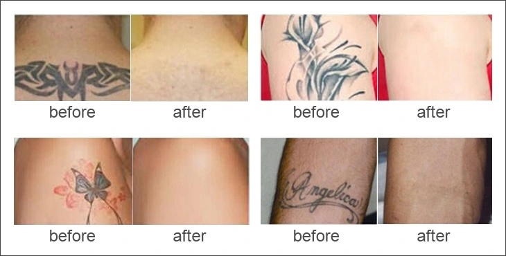 ND YAG Laser Machine for Tattoo Removal Skin Rejuvenation
