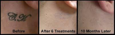 Q Switched ND YAG Laser Pigments Removal Picosecond