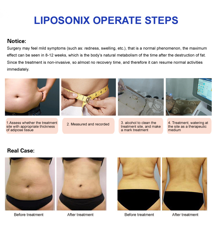 8mm &13mm Liposonix Hifu Lipohifu Slimming Machine for Body Weight Loss