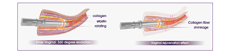 CO2 Fractional Laser Vaginal Tightening Skin Resurfacing Machine