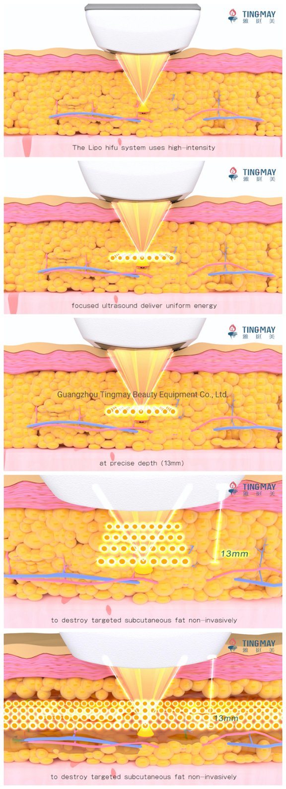Tingmay Non Invasive Liposonix Hifu Machine Skin Rejuvelation and Wrinkles Removal Hifu