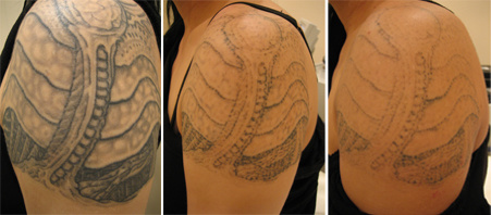 Tattoo or Tattoo Wound Treatment ND YAG Laser/Q-Switch ND YAG Laser