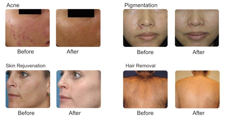 Shr IPL Hair Removal Machine Vascular Acne Treatment IPL Beauty Equipment