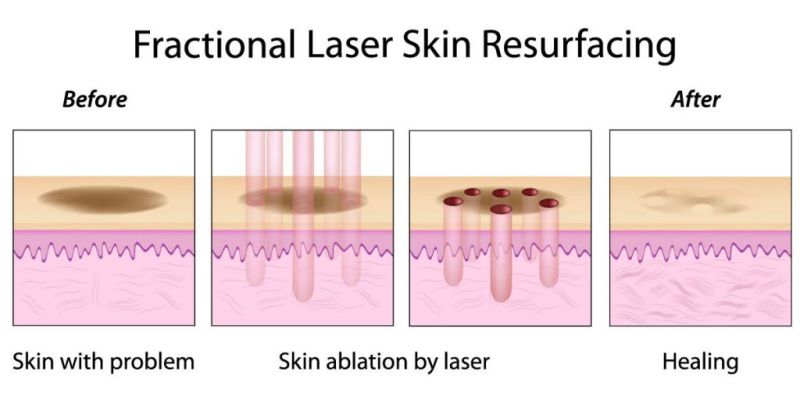 3D Fractional CO2 Laser Skin Resurfacing Beauty Equipment