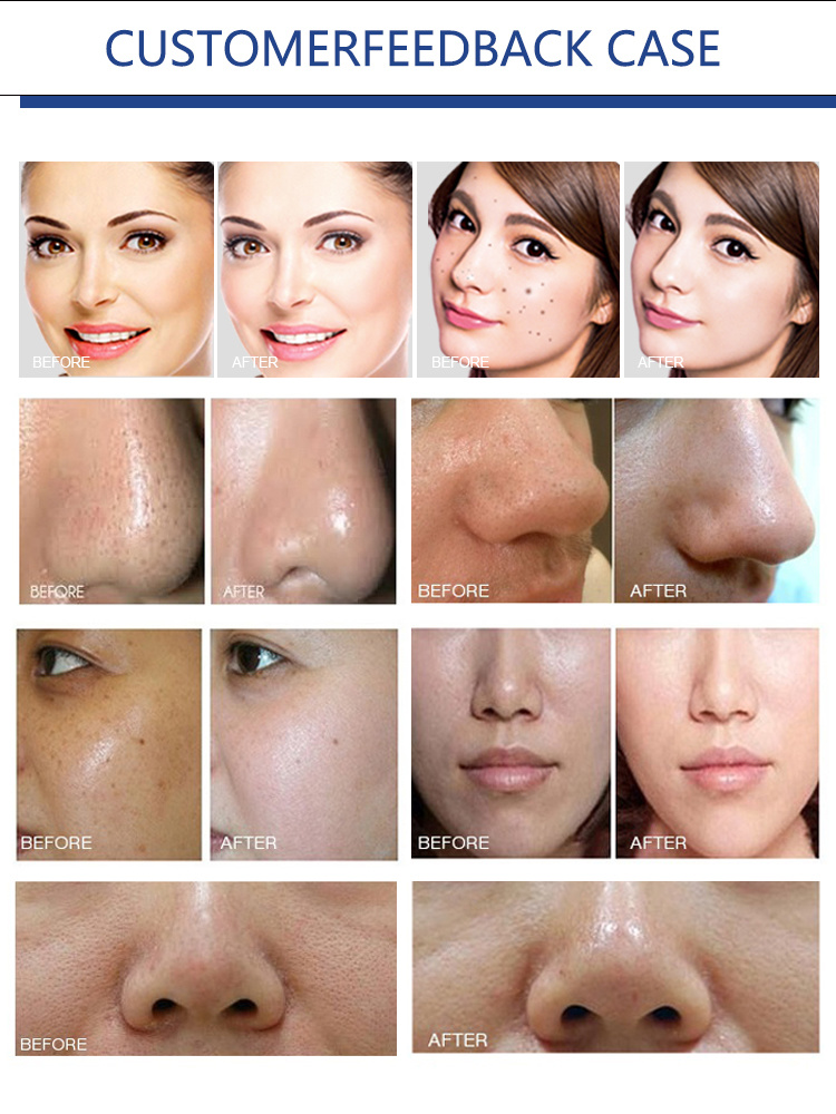 Popular Hydra Facial Microdermabrasion Skin Care Beauty Machine