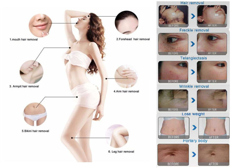 Summer Promotion Professional 3 in 1 IPL Hair Removal Machine/ IPL+Elight Shr/ IPL Fast Hair Removal Beauty Equipment