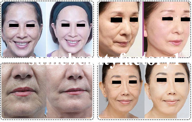 3D Hifu Face Lifting Wrinkle Removal Skin Tightening Facial Beauty Machine
