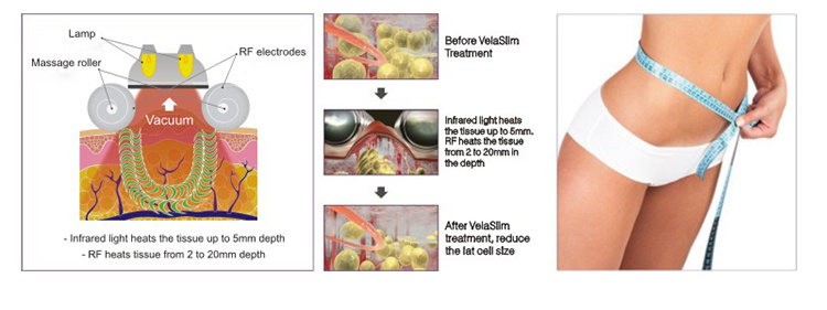 Hot Sale Velashape Body Slimming Machine Vacuum RF Body Slimming Machine