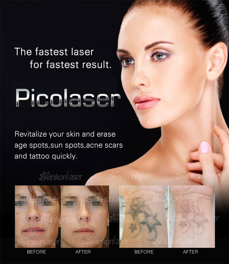 Super Picosecond Laser Tattoo Removal Machine Mini Tattoo Removal Laser