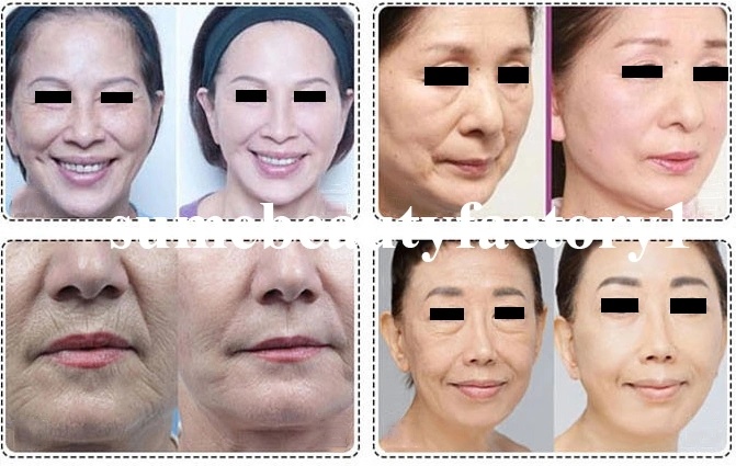 Newest 3D Hifu Beauty Equipment for Face Lift Skin Tightening