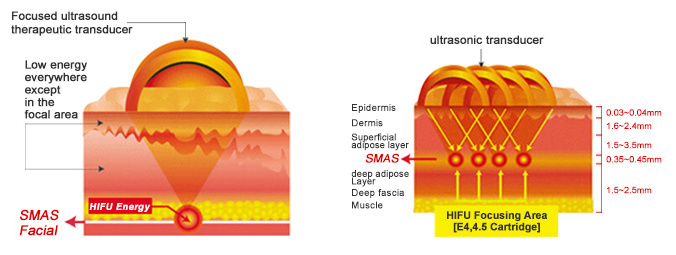 Trolley Hifu Ultrasound Machine Face Lifting Fat Removal for Sale