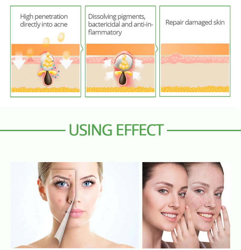 Mslam Acne Treatment Blackhead Removal Anti Acne Cream Oil Control Shrink Pores Acne Scar Remove Tea Treeface Care Whitening