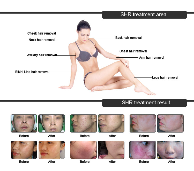 Aesthetic Machine Depilation Opt Shr IPL Hair Removal