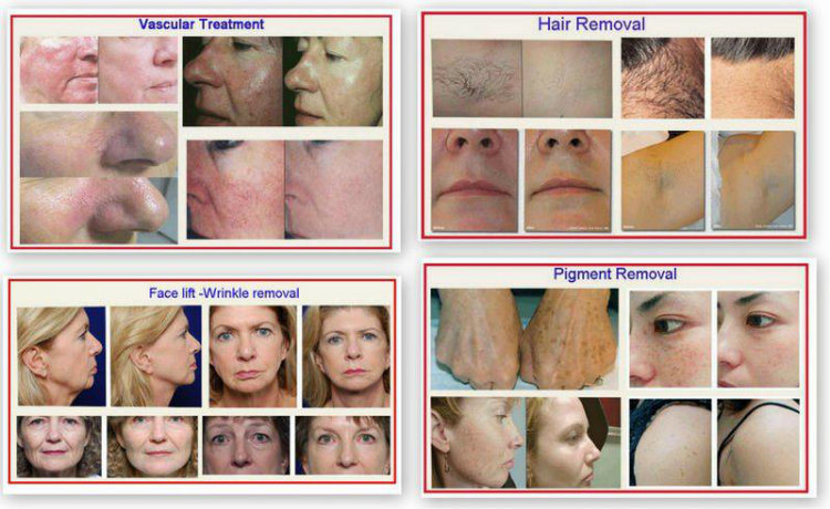 IPL for Hair Removal and Skin Rejuvenation Hs-300c