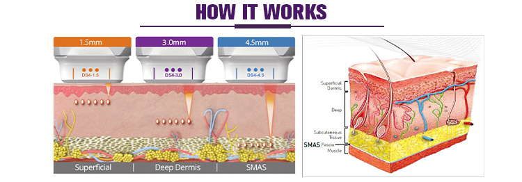 Superficial DELL Dermis and Smas Hifu Beauty Machine