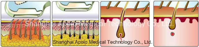 IPL Hair Removal Shr Laser Hair Removal Skin Rejuvenation Acne Tretament Machine for Sale