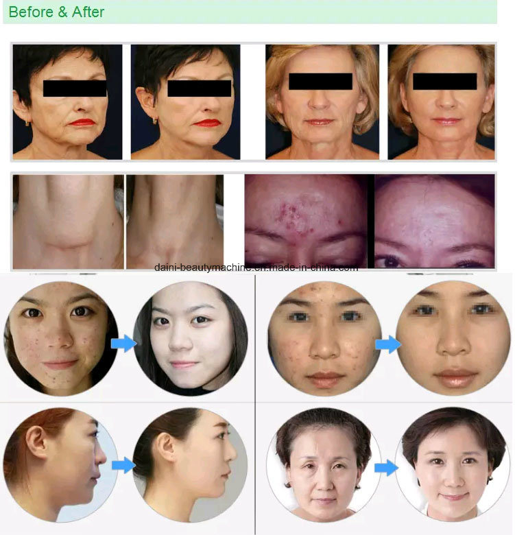 PDT Skin Whitening LED Light PDT Machine /Skin Rejuvenation Therapy Machine