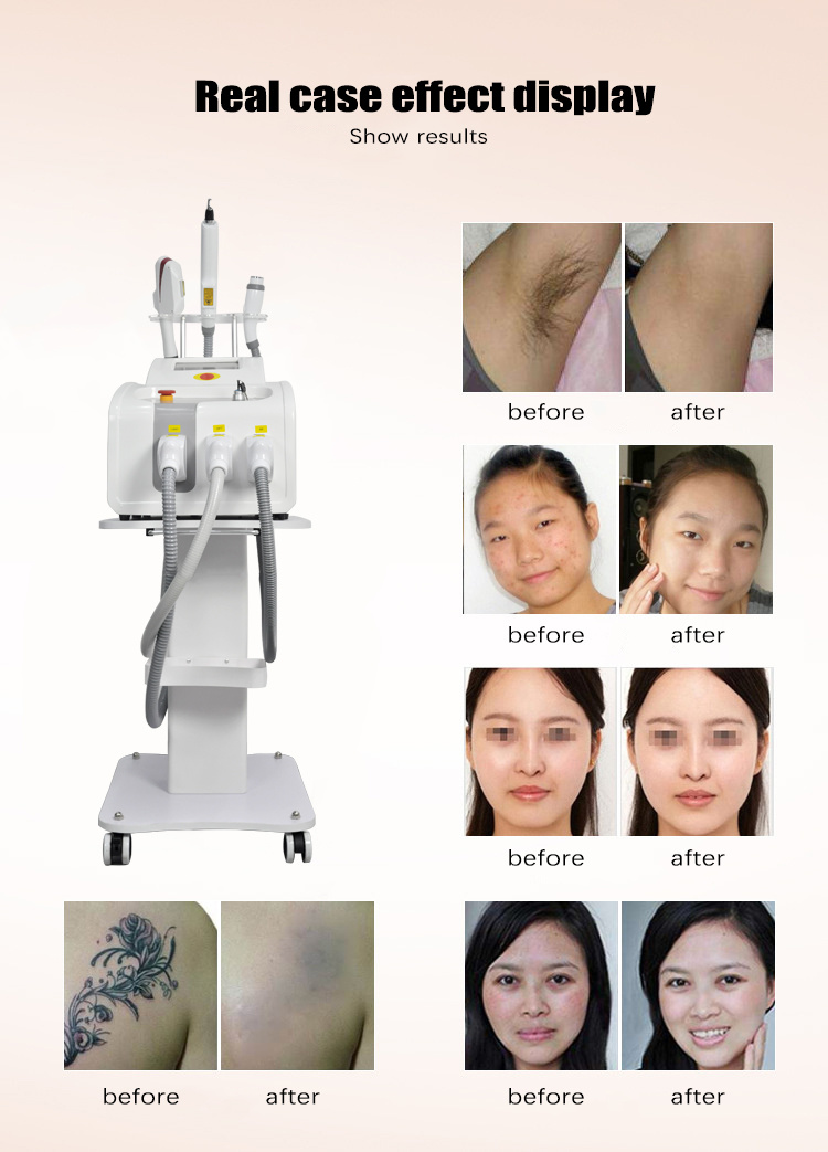 Professional Beauty Laser 3 in 1 Shr Elight IPL Laser Hair Removal Machine IPL Hair Removal Portable for Sale
