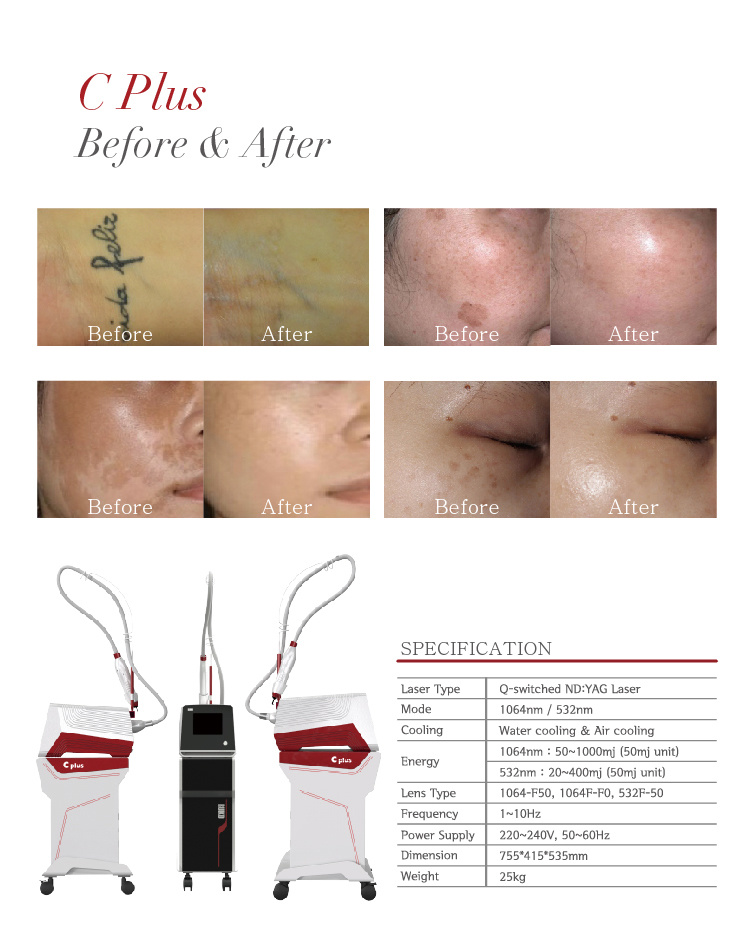 Korea Q-Switch ND YAG Laser Skin Care / Tattoo Removal Salon Instrument
