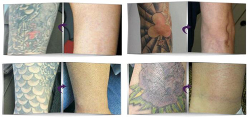 Laser Pigment Therapy / Q Switch ND YAG Laser Tattoo Removal Equipment