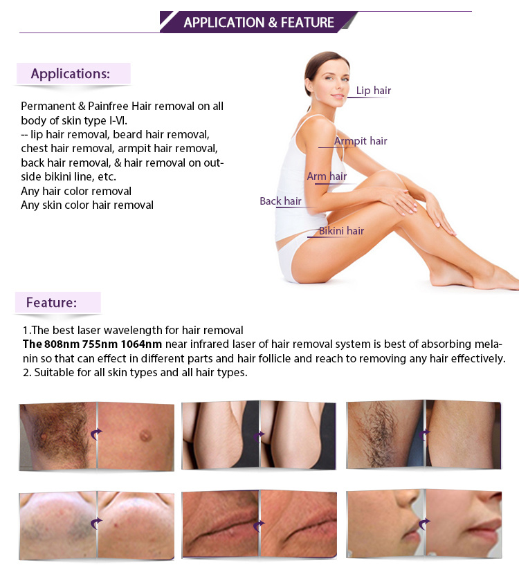 Depilacion Diode Laser for Hair Removal 808nm Beauty Machine
