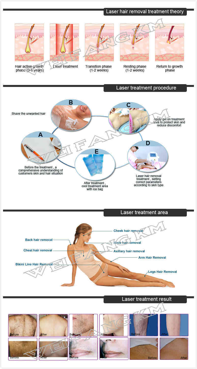 Laser Diode Epilazione Permanente Super Diode Laser Hair Removal