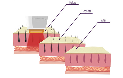 Muilt-Function IPL Diode Laser Permanent Hair Removal Machine