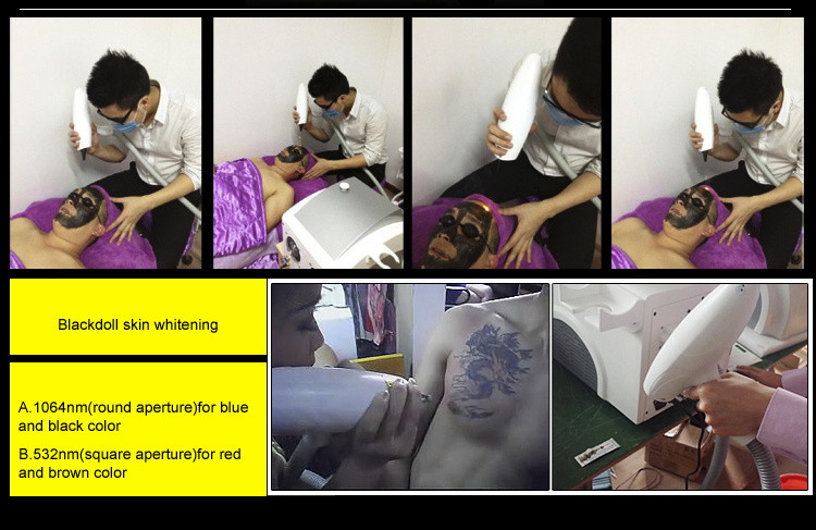 Good Quality Tattoo Removal ND YAG Laser Machine Prices