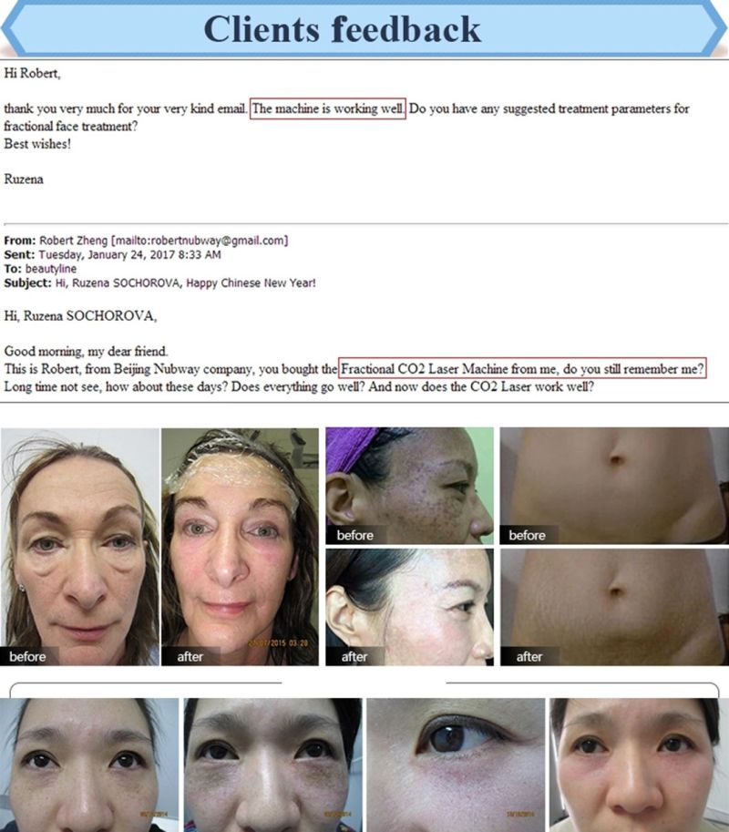 Laser Wrinkle Removal Before and After RF Excited CO2 Fractional Laser Skin Tightening Equipment