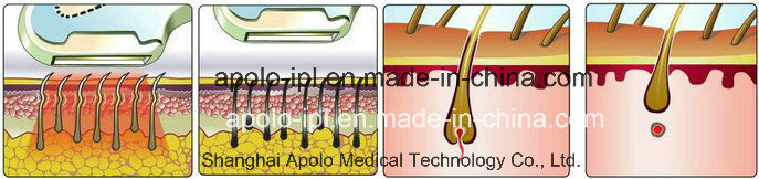 Apolomed Hot Sale IPL Beauty Equipment for Hair Removal and Skin Rejuvenation