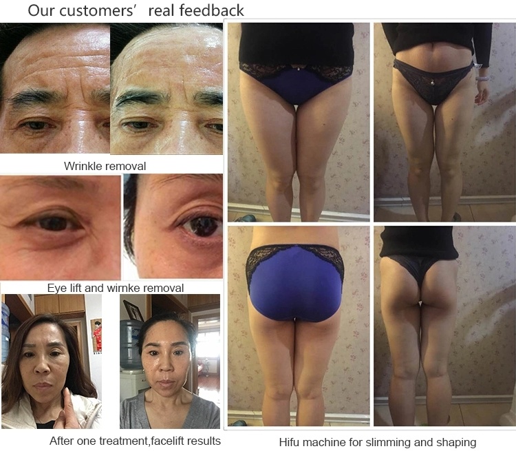 Mini Portable Korean Hifu Facial Removal Body Slimming Smas Lifting Beauty Salon Use Machine