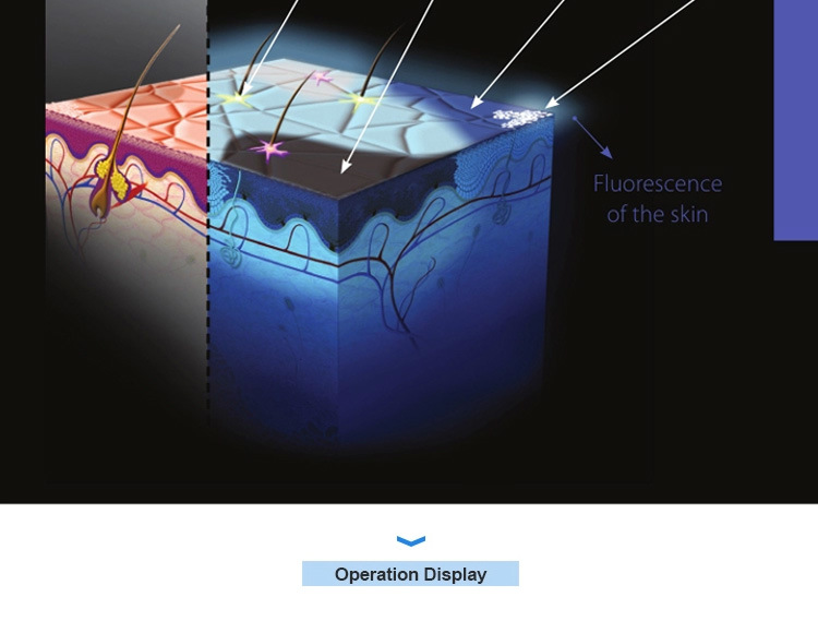 Hifu Machine 3D Digital Observe Facial Skin Analyzer